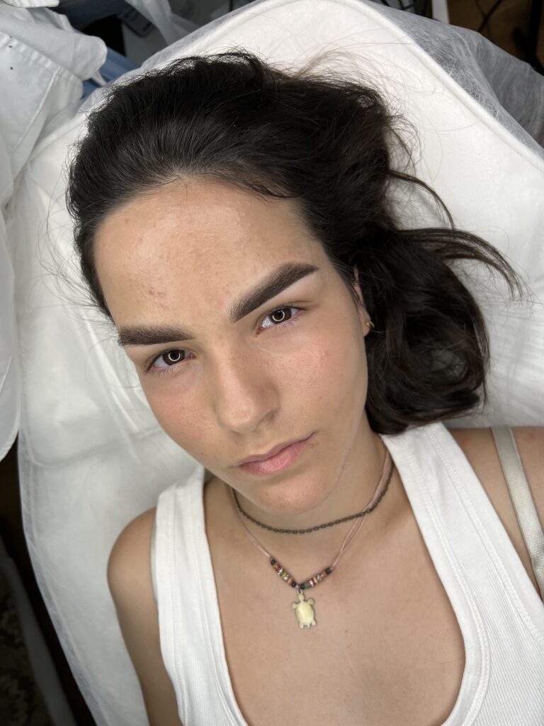 trattamento pmu sopracciglia